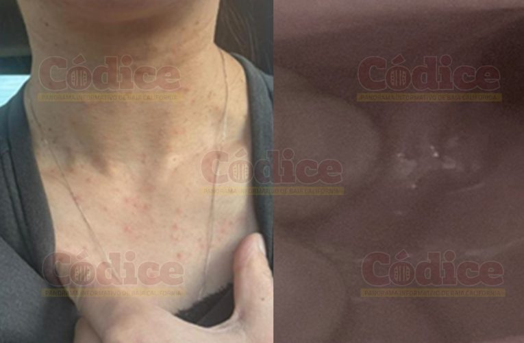 Confirman caso de sarampión en Tecate